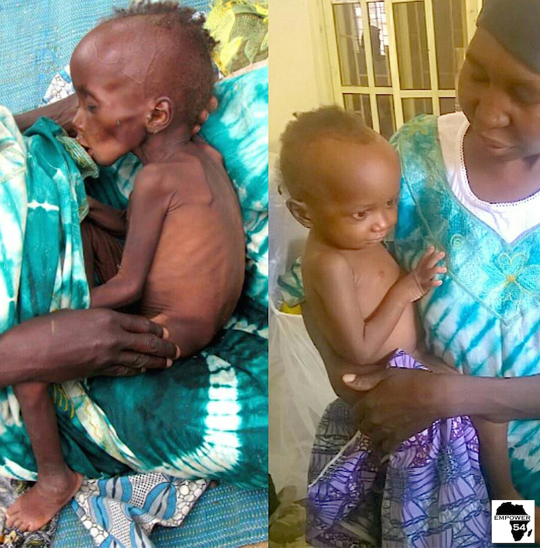 Malnourished Bama children recover!