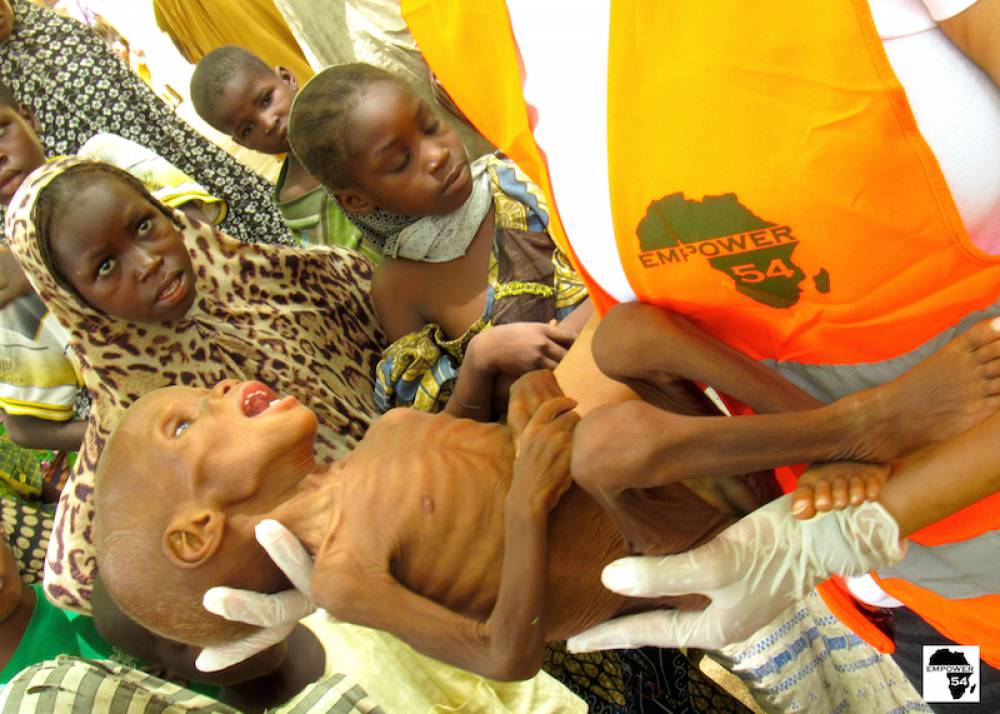 1,800 severely malnourished children evacuated for treatment